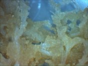 Dissecting scope of same hyerpvascular villi