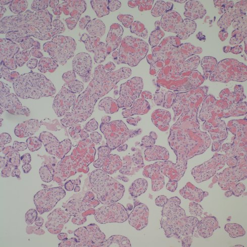 Lympho-histiocytic villitis and hypervascular villi