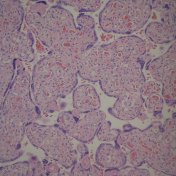 Diffuse increased vascularity