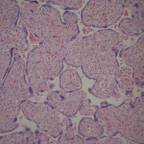 Diffuse increased vascularity