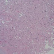 Diffuse increased vascularity
