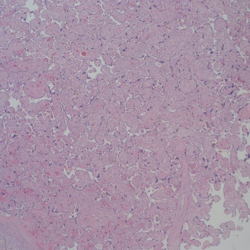 Diffuse increased vascularity