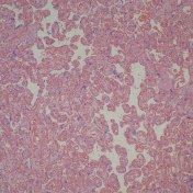 Dilated villous capillaries above a retroplacental hematoma
