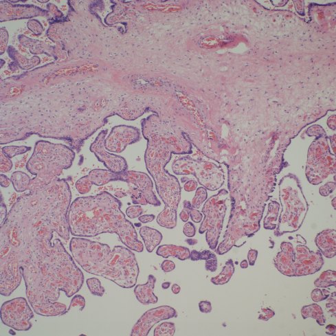 Normal stem villus with attached branch showing capillary proliferation