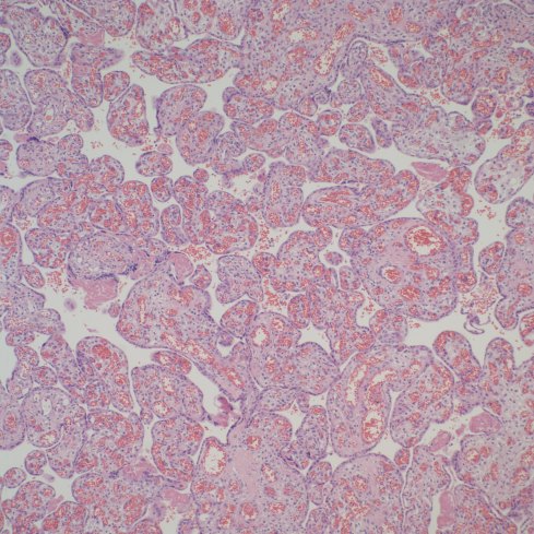 Placental villi from an aborted Potter syndrome fetus at 23 weeks gestation