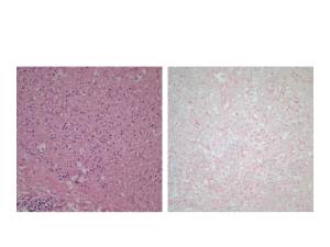 Spleen, left H&E 20x, right iron stain 40s showing pale hemosiderin macrophages.
