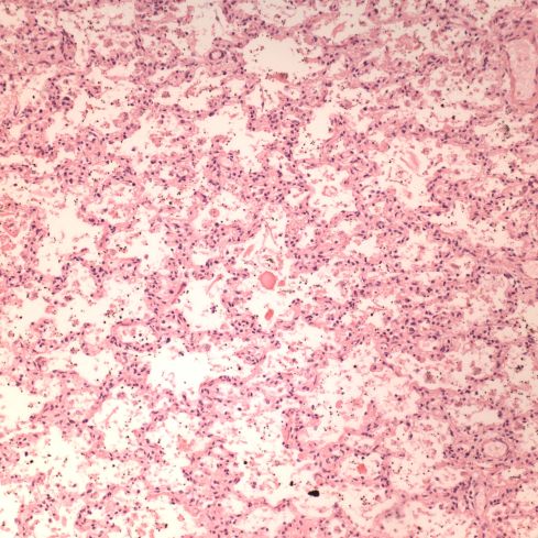 Fig 6 CA02-94_20xlung