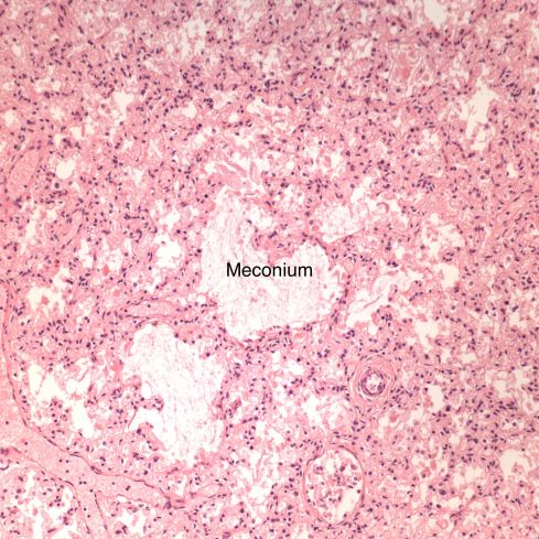 fig 6 CA98-26_20x lung