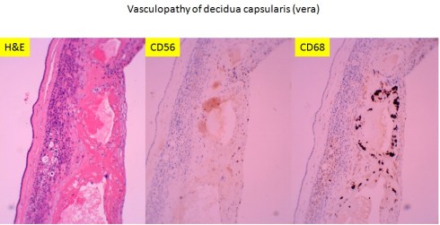 Decidua vera vasculopathy